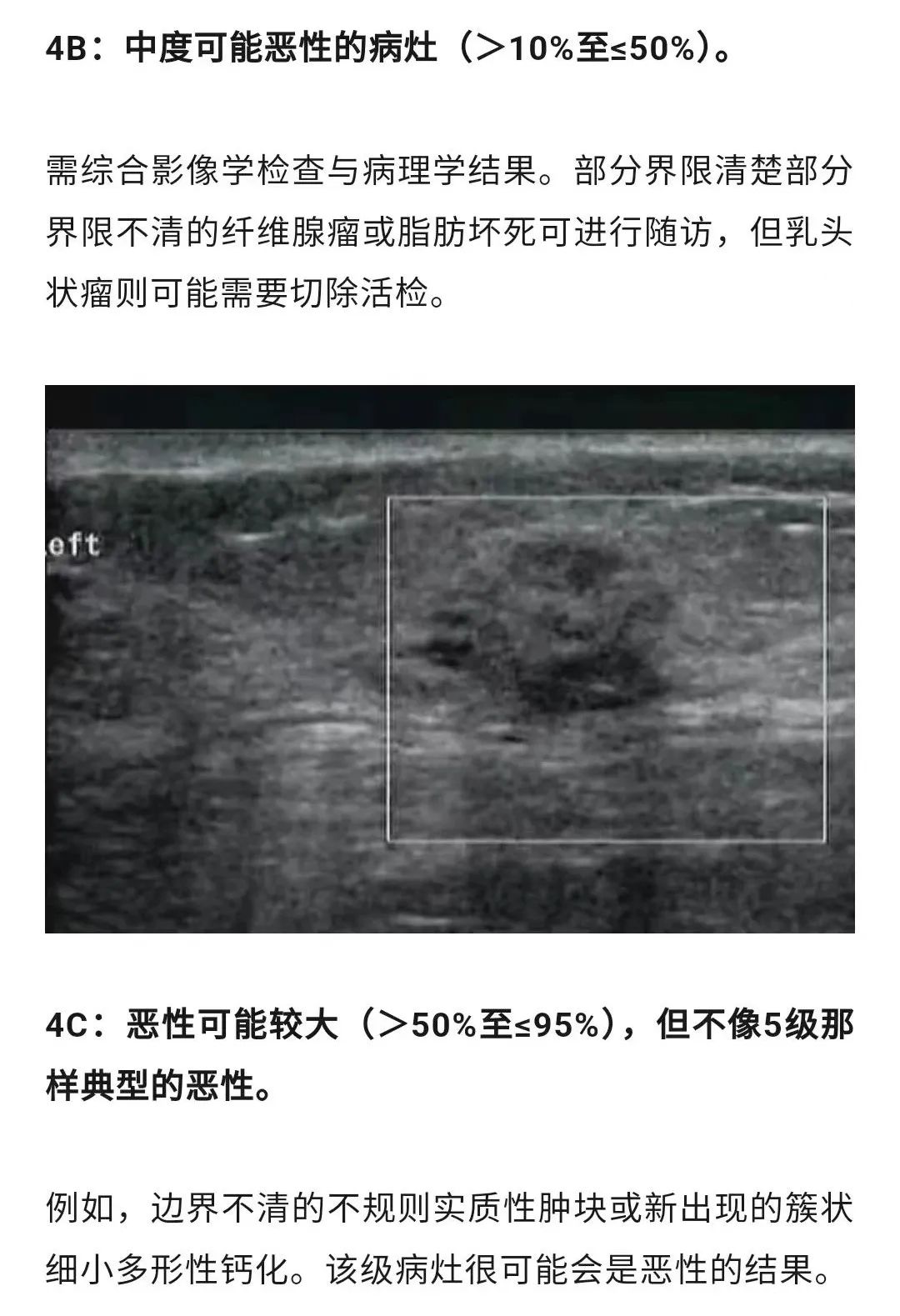 乳腺結(jié)節(jié)惡性的可能性有多大？一文讀懂乳腺結(jié)節(jié)BI-RADS分級(jí)標(biāo)準(zhǔn)！